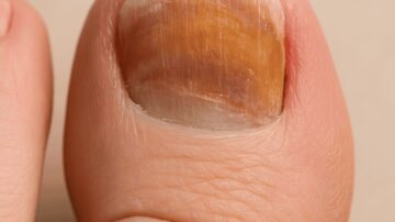 Szinte mindenkinek vannak ilyen vonalak a körmein, de csak kevesen tudják, mit jelentenek