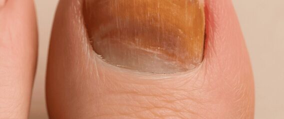 Szinte mindenkinek vannak ilyen vonalak a körmein, de csak kevesen tudják, mit jelentenek